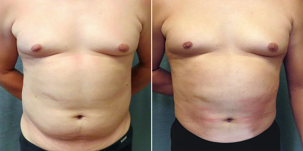 Male Body Contouring & Liposuction