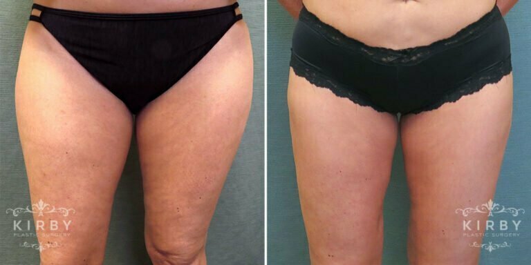  Female patient before and after liposuction Fort Worth