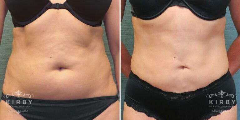  Female patient before and after liposuction Fort Worth