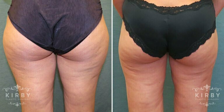  Female patient before and after liposuction Fort Worth