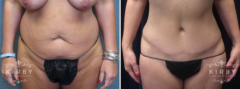 Tummy Tuck G1217