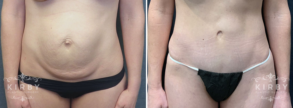 Tummy Tuck G1218