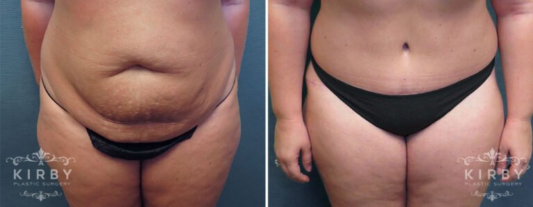 Female patient before and after tummy tuck Fort Worth