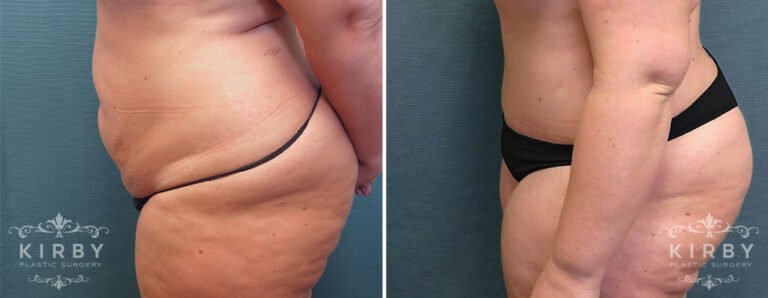 Female patient before and after tummy tuck Fort Worth