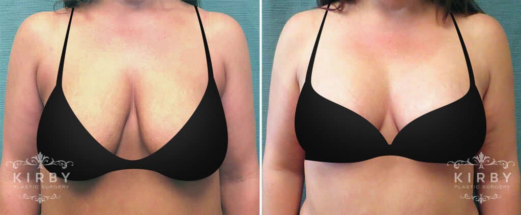 Silicone Scar Anchors  Post-Surgical Breast Augmentation