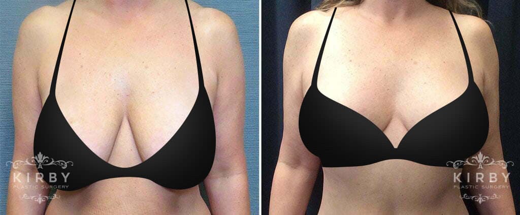 Asymmetrical women breast shape lift nipple silicone surgery