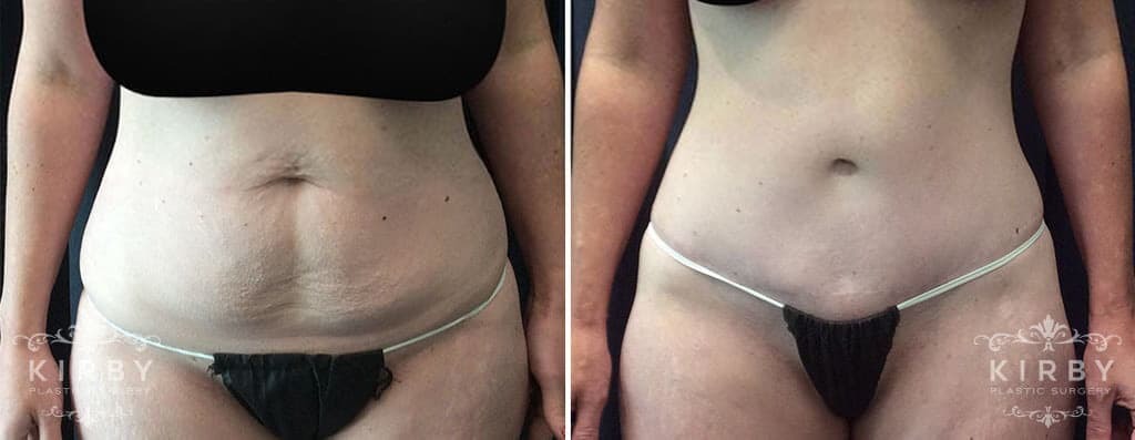 Patient of Fort Worth plastic surgeon Dr. Emily Kirby shown before and after full abdominoplasty and power-assisted liposuction of the flanks (love handles) and inner/outer thighs