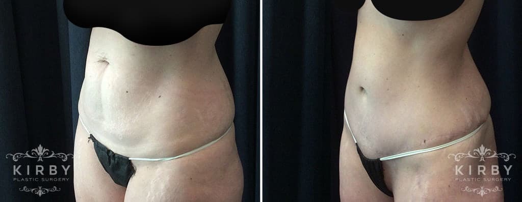 Patient shown before and after tummy tuck with Fort Worth plastic surgeon Dr. Emily Kirby