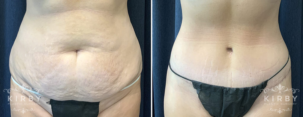 Tummy Tuck G882