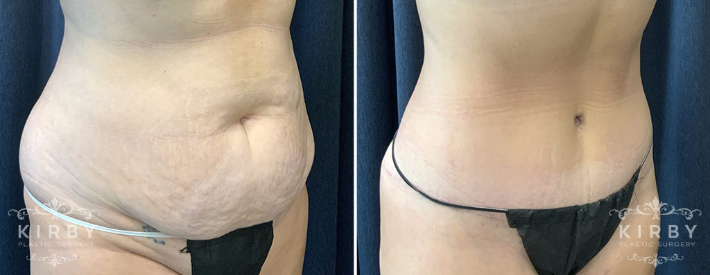 Female patient before and after full tummy tuck Fort Worth