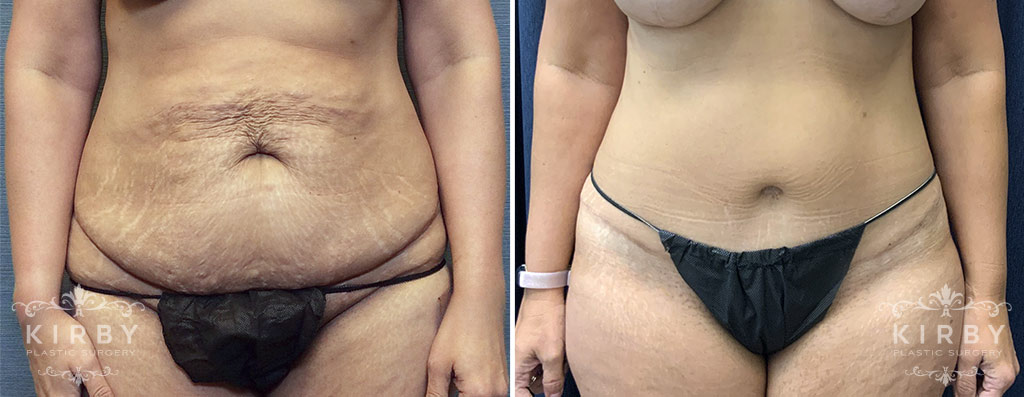 Female patient before and after full tummy tuck Fort Worth