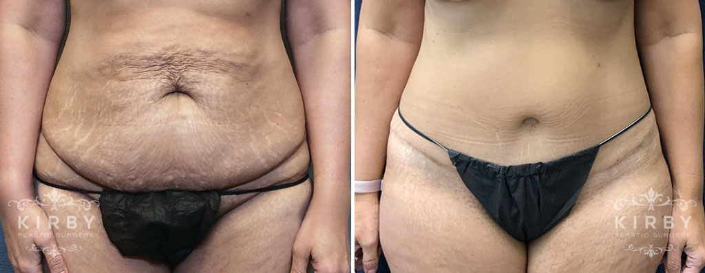 Female patient before and after a mommy makeover with tummy tuck in Fort Worth, TX. 