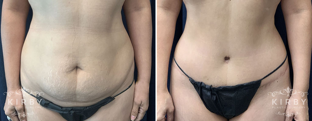 Tummy Tuck G1026