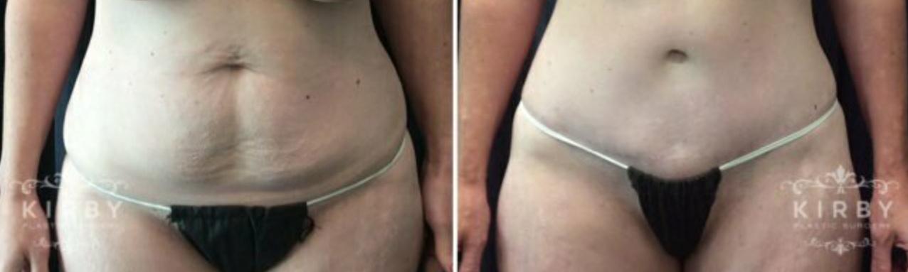 Female patient before and after full tummy tuck Fort Worth