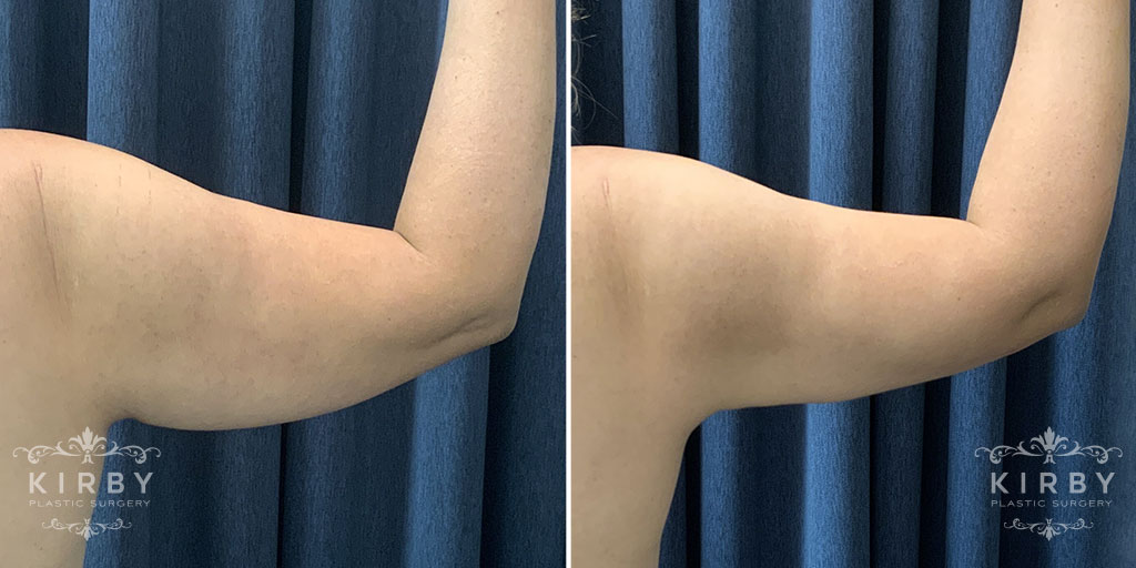 Arm Rejuvenation G11026