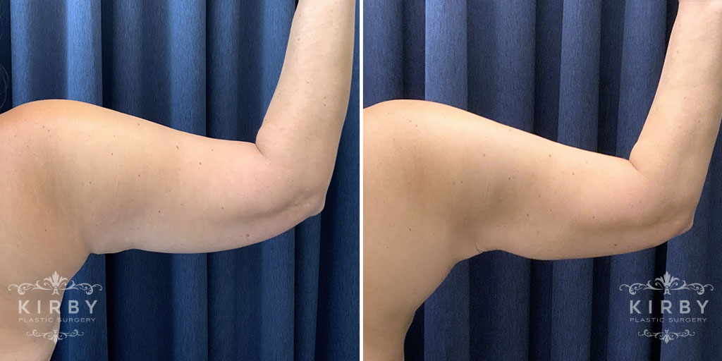 Upper Arms Liposuction G1820