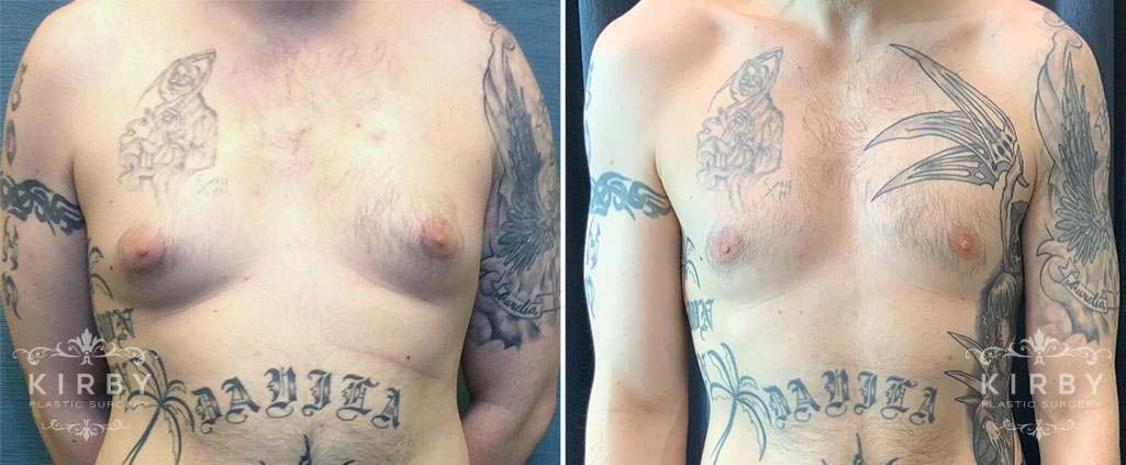 Male breast reduction patient before and after gynecomastia surgery Fort Worth. Front view.