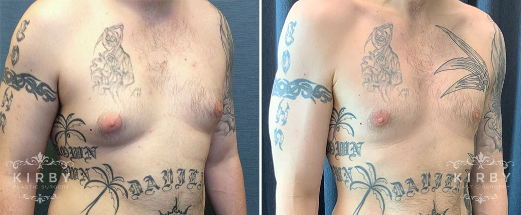 Male breast reduction patient before and after gynecomastia surgery Fort Worth. Quarter view.