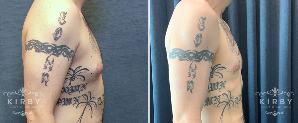 Male breast reduction patient before and after gynecomastia surgery Fort Worth. Profile view.