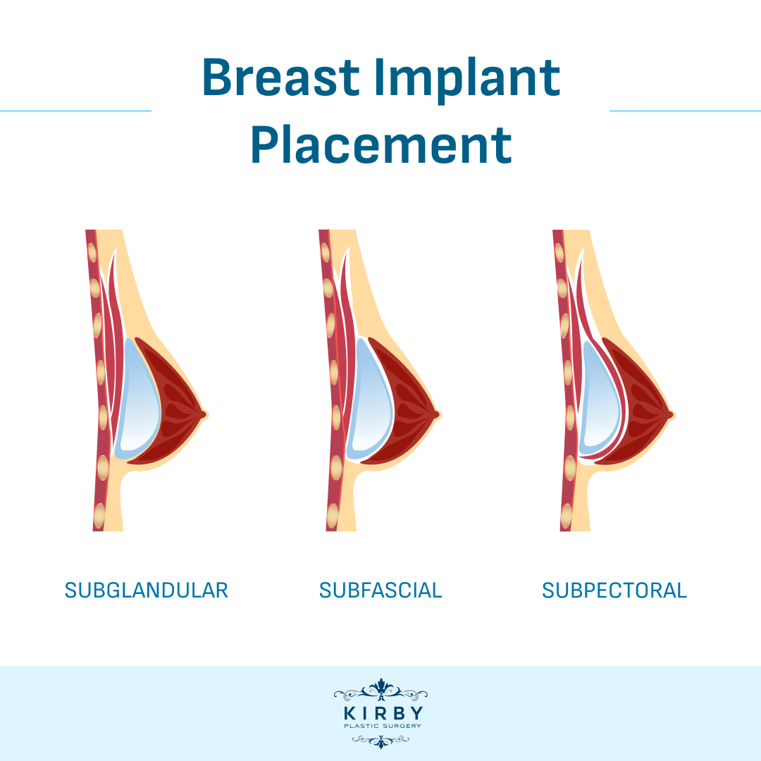 Breast implant placement infographic