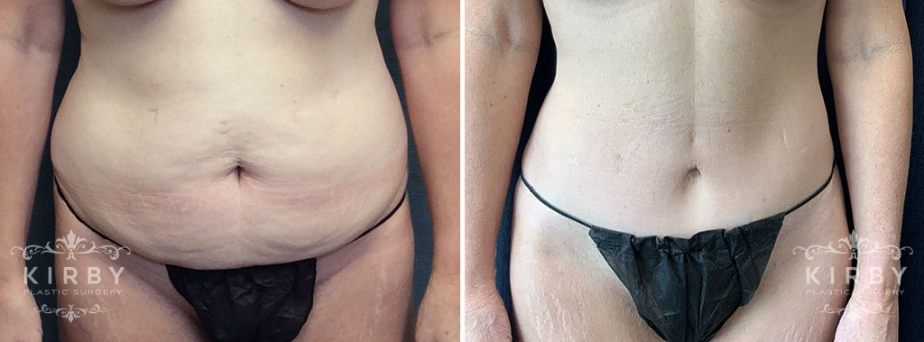 Before and after mommy makeover with tummy tuck