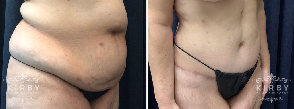 Female patient before and after a mommy makeover with tummy tuck in Fort Worth, TX. Quarter profile view.