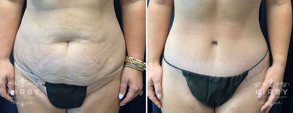 Female mommy makeover patient shown before and after a tummy tuck with Dr. Kirby