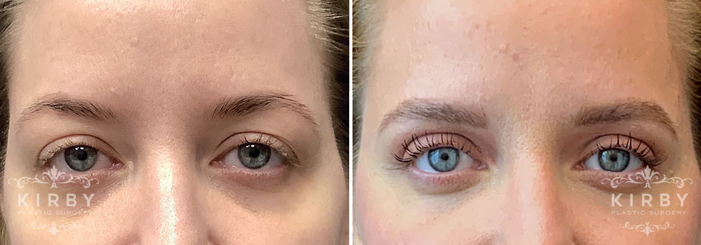 Brow Lift and Upper Eyelid Lift G1954